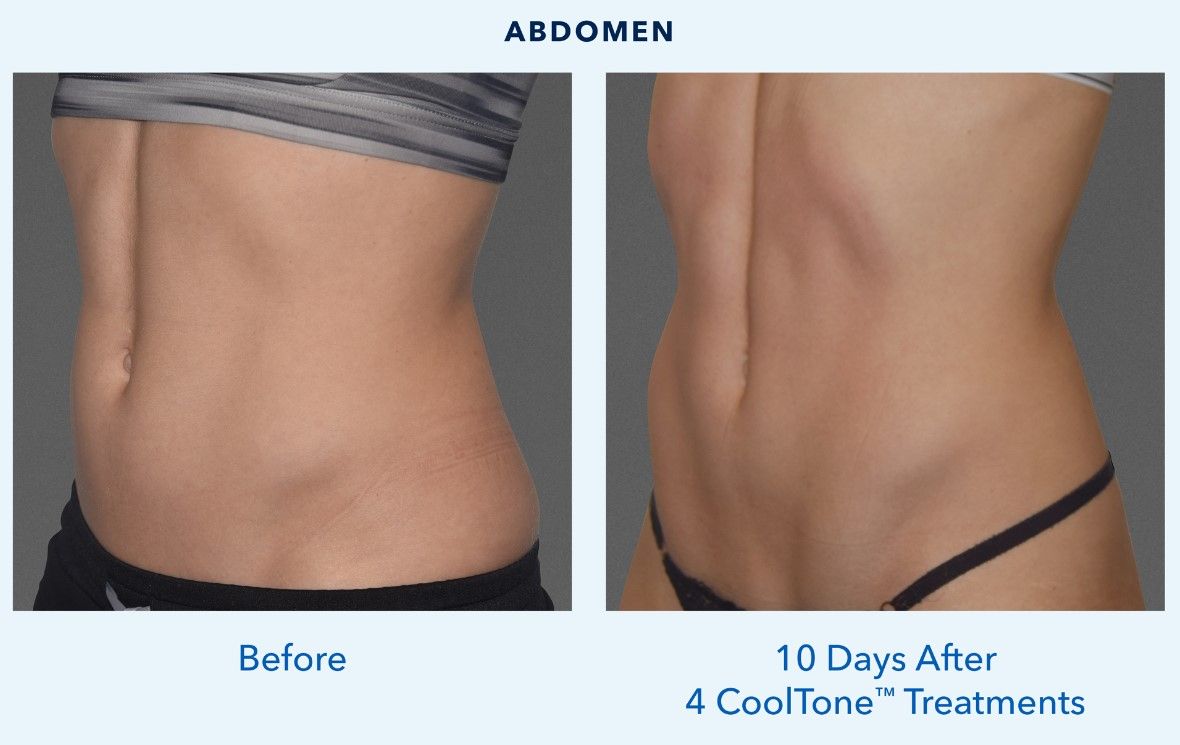 Abdominal transformation before and after treatment.