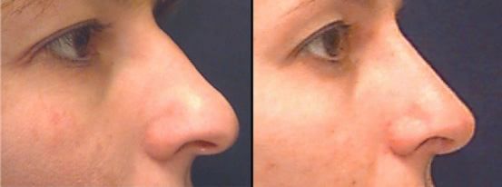 Before and after nose reshaping comparison image