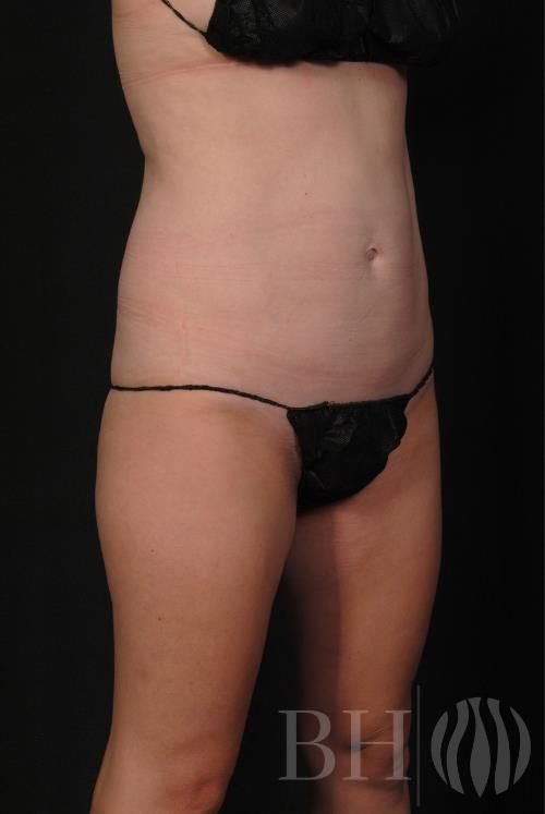 Coolsculpting Before & After