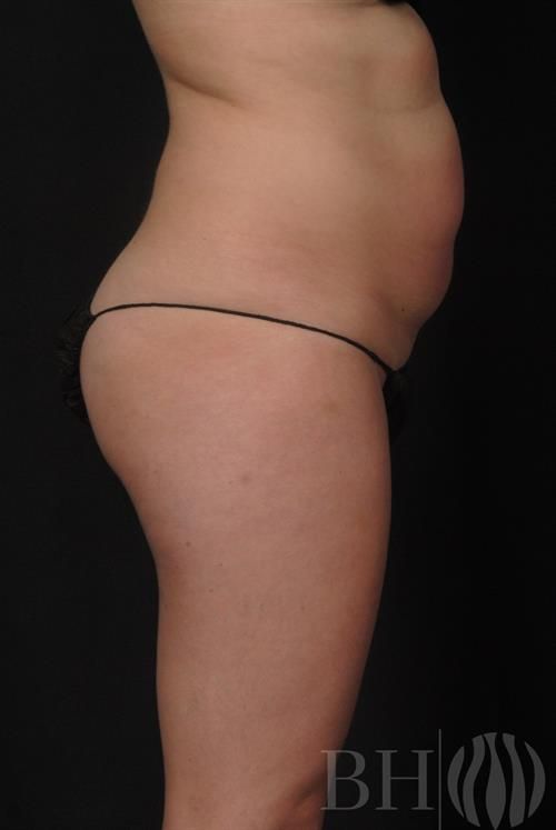 Coolsculpting Before & After