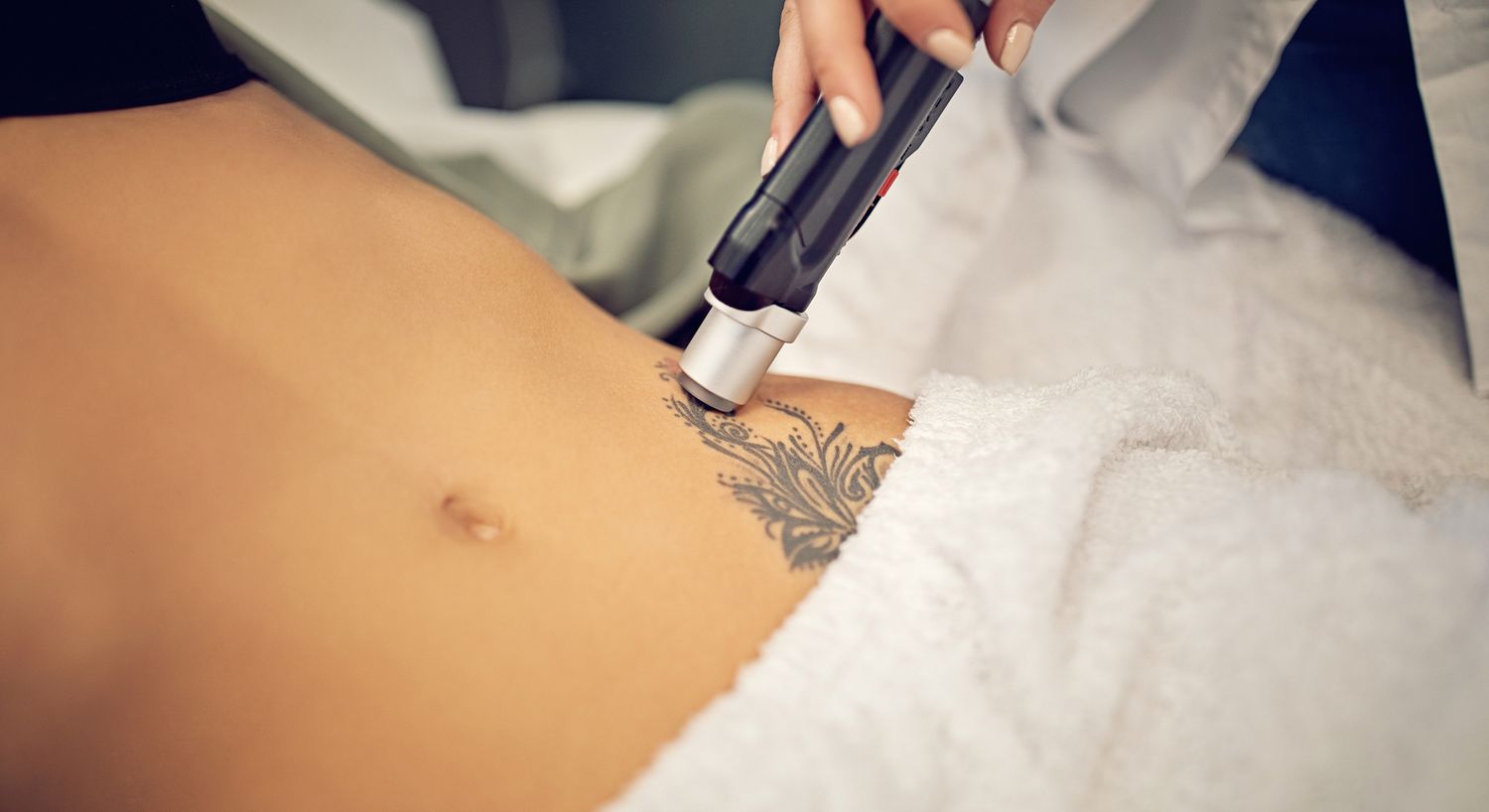 Laser treatment on a tattooed abdomen.